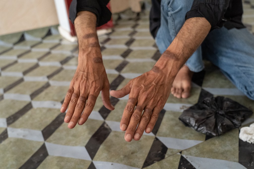 Majli shows the scars on his knuckles and arms from chewing the skin any time he thinks of Abu Ghraib, a habit he picked up in the prison.